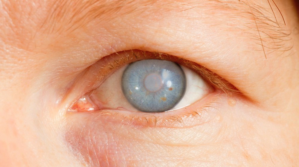 Glaucoma congênito: entendendo a condição que afeta os pequenos